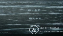 麻醉与围术期医学科开展新技术——超声引导下腹横肌平面阻滞