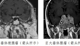 神经外科成功手术治疗“巨大”、“微小”2例垂体腺瘤