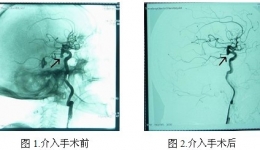80岁高龄患者颅内动脉瘤破裂被成功治愈