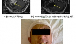 巨大复发听神经瘤复成功手术切除