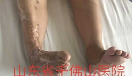 骨创伤外一科Taylor外固定架非融合治疗创伤性马蹄内翻足