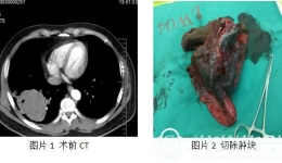 多学科会诊成功救治肺巨大恶性肿瘤患者一例