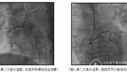 心内二科完成山东首例ECMO辅助下急诊PCI