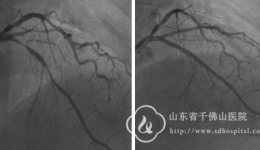 社区—全科—心内联动，成功救治1例急性心肌梗死患者