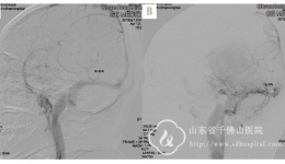 神经外三科成功切除一例松果体区巨大脑膜瘤