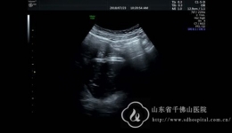 妇二科完成一例腹腔镜下骶前畸胎瘤切除术