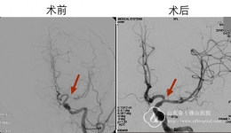 神经内四科为27岁小伙解除偏瘫威胁