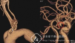 神经外一科完成一例微小后交通动脉瘤栓塞治疗