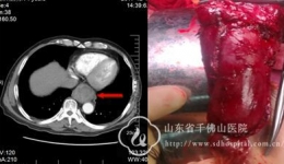 胸外二科近日完成两例巨大食管肿瘤切除术