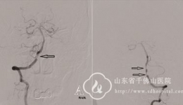 回天有“术”—记神经外一科一例双侧椎动脉多发狭窄患者