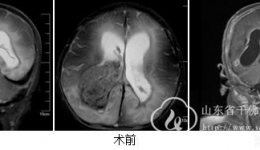 神经外三科成功为2月龄婴儿脑室巨大肿瘤并脑积水实施手术