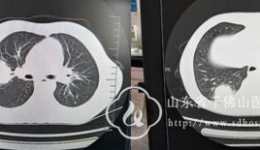 小儿血液内分泌科亲缘单倍体造血干细胞移植成功救治一例重症MDS患儿