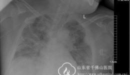 重症医学科首次应用ECMO成功抢救一例重症肺炎患者