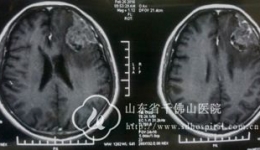 边手术边与患者实时交流  保全患者语言运动功能