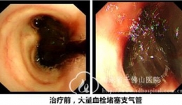 呼吸内科完成一例气管内血栓取出术