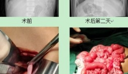 小儿外科成功治愈一例先天性膈疝患儿