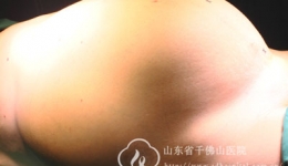 妇科成功为一患者切除11公斤巨大阔韧带肌瘤