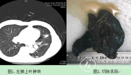 胸外二科完成1例高龄患者肺癌肺段切除术