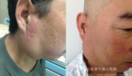 我院首例神经外科杂交手术治愈罕见头面颅颈部巨大动静脉瘘