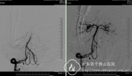 神经内四科接力合作医院成功抢救一例基底动脉尖综合症患者