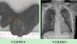 胸外二科成功完成一例重症肺功能障碍肺癌手术