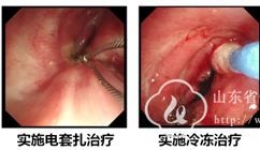 呼吸科联合疗法完成一例老年严重气道狭窄介入治疗