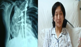 我院重症医学科（ICU）成功抢救一例严重脊柱畸形合并