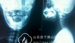 儿童歪脖疼痛需警惕 及时诊断莫延误治疗