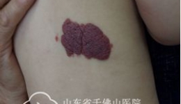 小小溶药包  浓浓关爱情