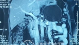 肝胆外二科全腹腔下镜下切除罕见腹膜后巨大淋巴管囊肿