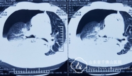 胸外二科收治一例食管穿孔患者
