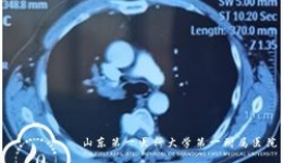 呼吸与危重症医学科氩气刀联合冷冻治疗大气道内肿瘤1例