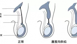 勿以“疝”小而不为，小儿疝气不容忽视