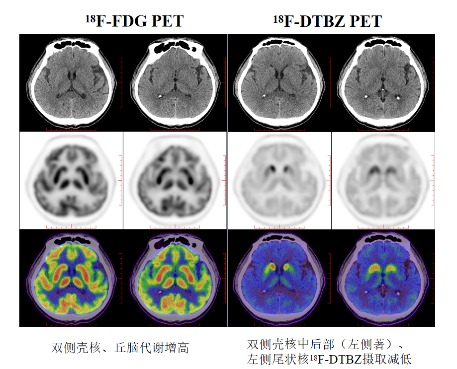 帕金森诊断新“镜”界18F-FDG &18F-DTBZ PET脑成像