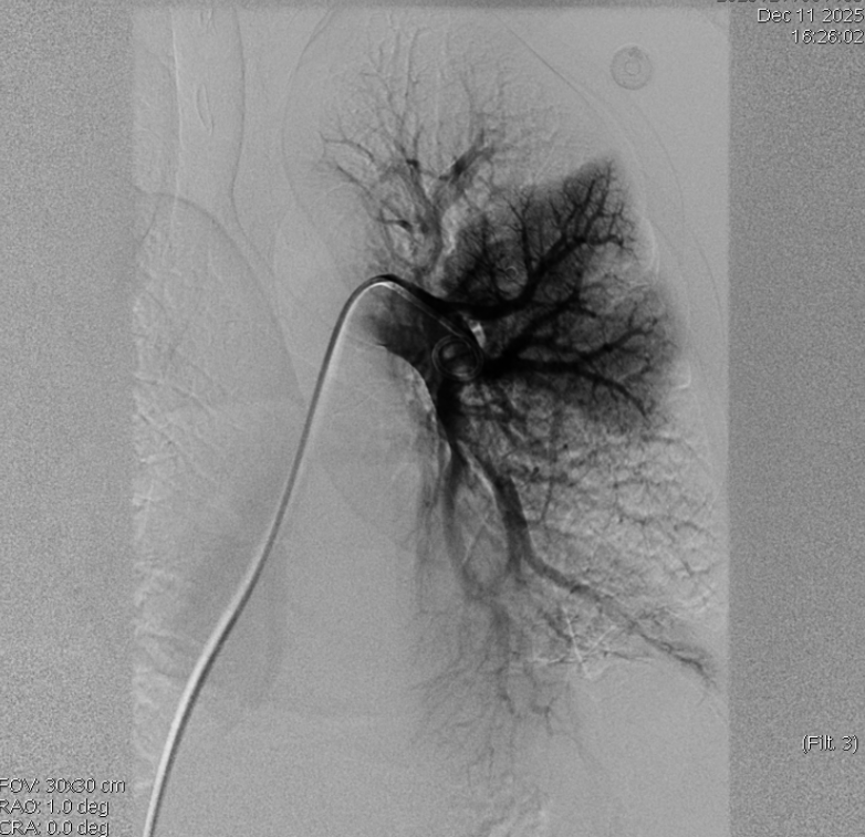 医院经皮肺动脉取栓支架系统取栓成功救治一例急性PTE伴咯血者