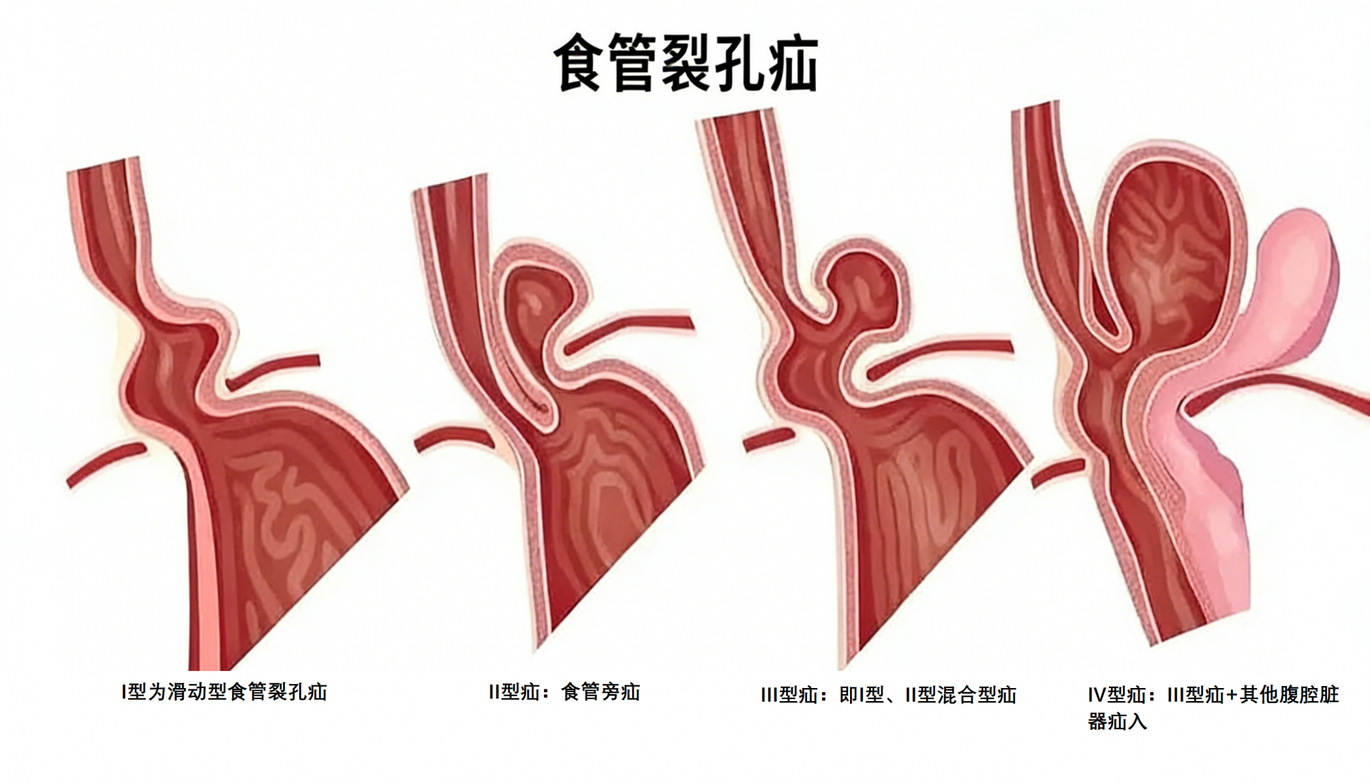 深耕疝病诊疗，疝与腹壁外科微创技术造福食管裂孔疝患者