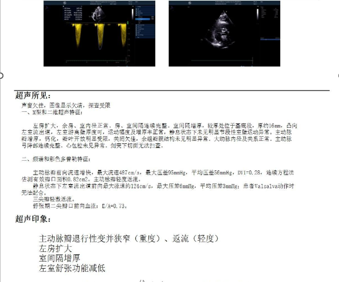 高血压科完成一例Type1型二叶瓣极简式TAVR手术