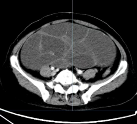 重达10余斤肿瘤成功切除——医院妇科肿瘤科成功为一例患者切除巨大卵巢肿瘤