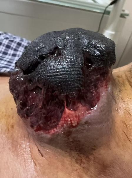 多学科协作攻克手术禁区，耳鼻喉科成功救治一例晚期甲状腺癌患者