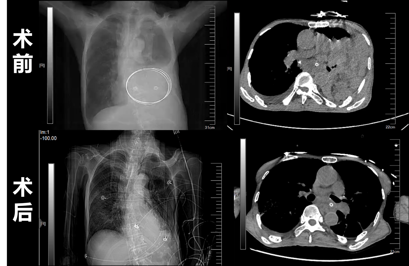微创“补漏”解疝患——医院膈疝个体化诊疗显成效