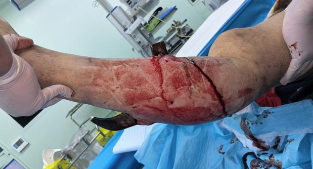 农机挤压犁刀贯穿致下肢动脉多处挤压断裂，多学科联合保肢成功