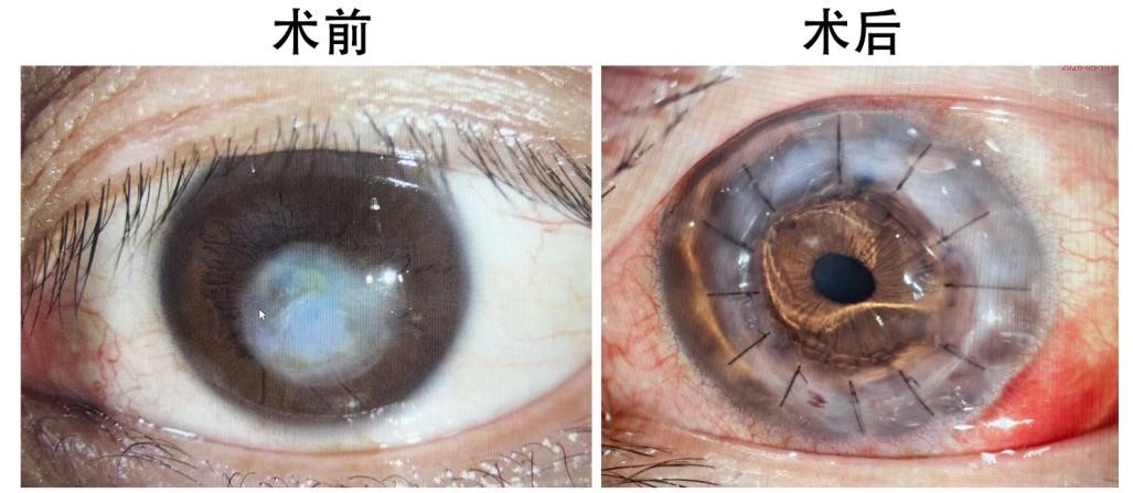 医院角膜移植术为两例角膜病患者点亮光明